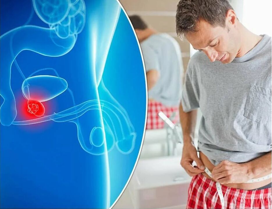 Symptômes et causes de l'inflammation de la prostate
