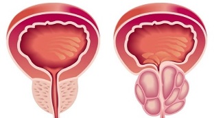 Raisons du développement de la prostatite et de l'adénome de la prostate